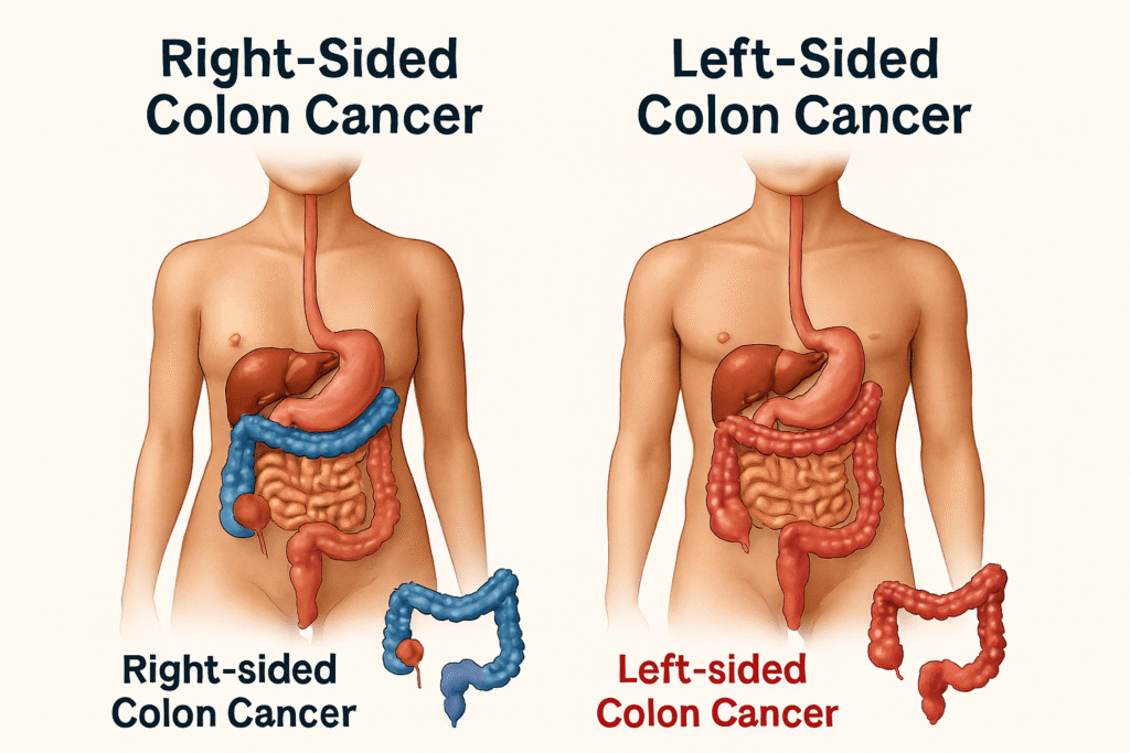 colon cancer tumor locations in men and women